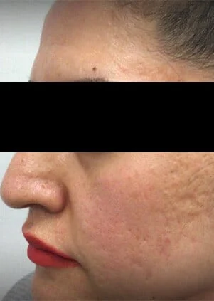 Antes del tratamiento