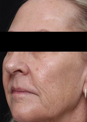 Antes del tratamiento