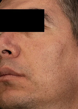 Después del tratamiento