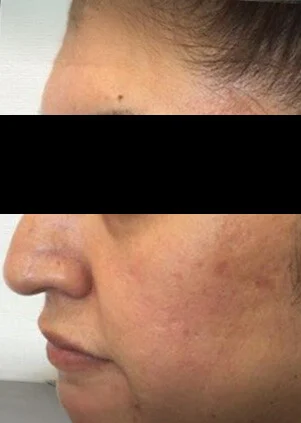 Después del tratamiento