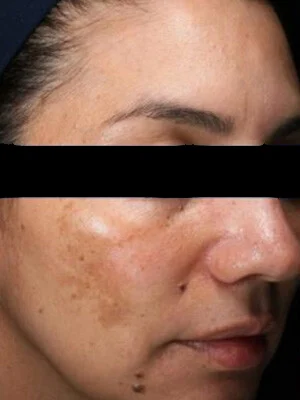 Antes del tratamiento