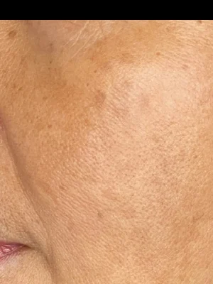 Después del tratamiento