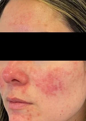 Antes del tratamiento