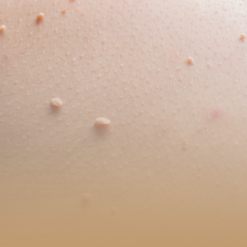 Eliminación Verrugas