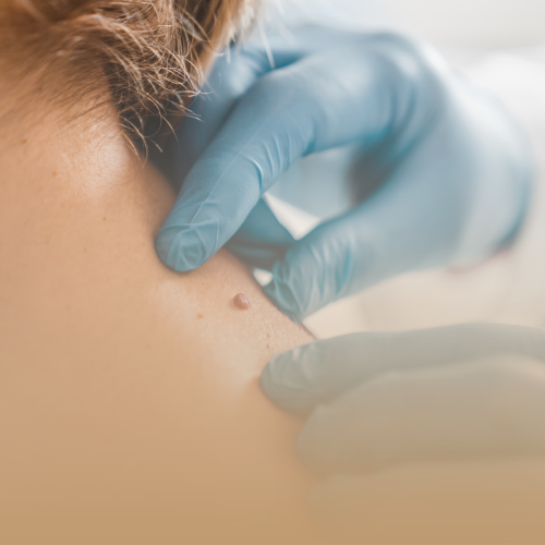 Eliminación Lunares