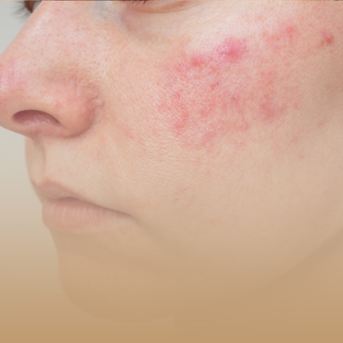 Tratamiento Rosácea