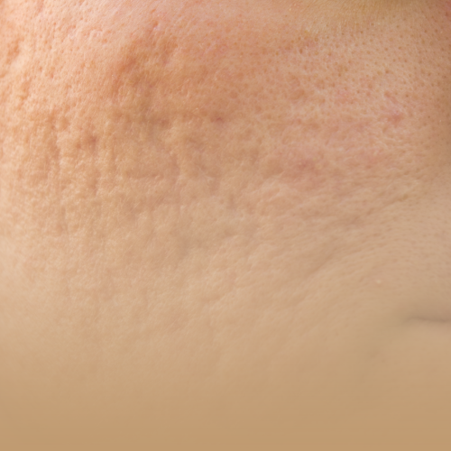 Tratamiento Marcas de Acné