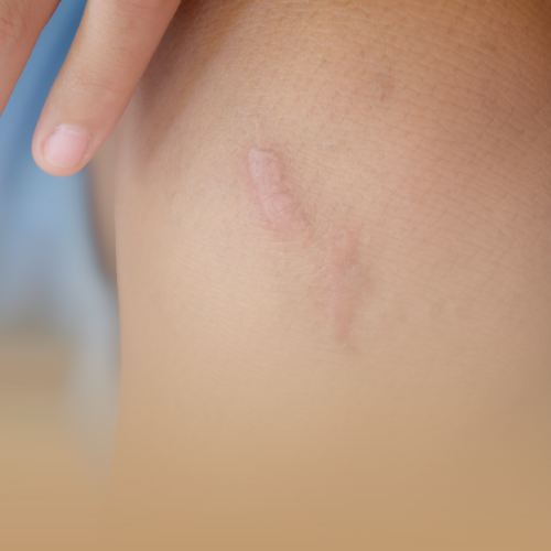 Eliminación Cicatrices / Queloides