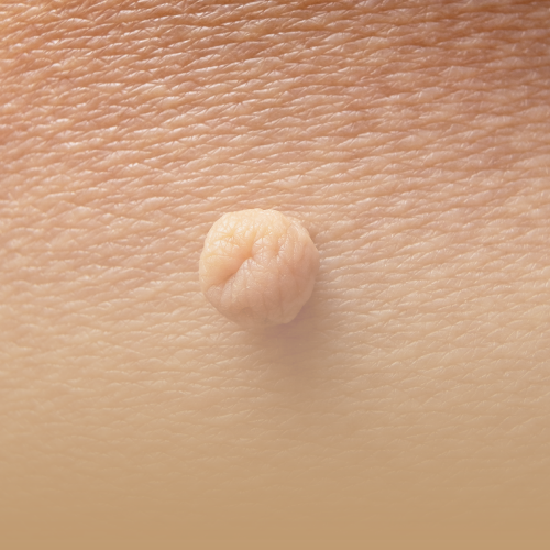 Tratamiento Fibromas Cutáneos