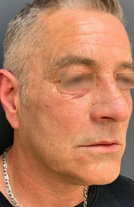 Suavizado de Arrugas