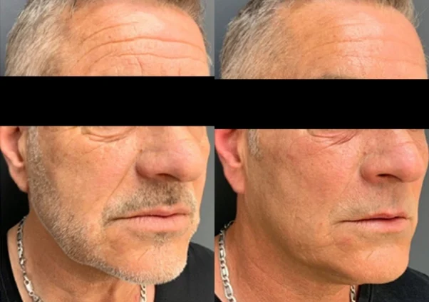 Rejuvenecimiento facial